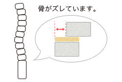 骨がズレています。